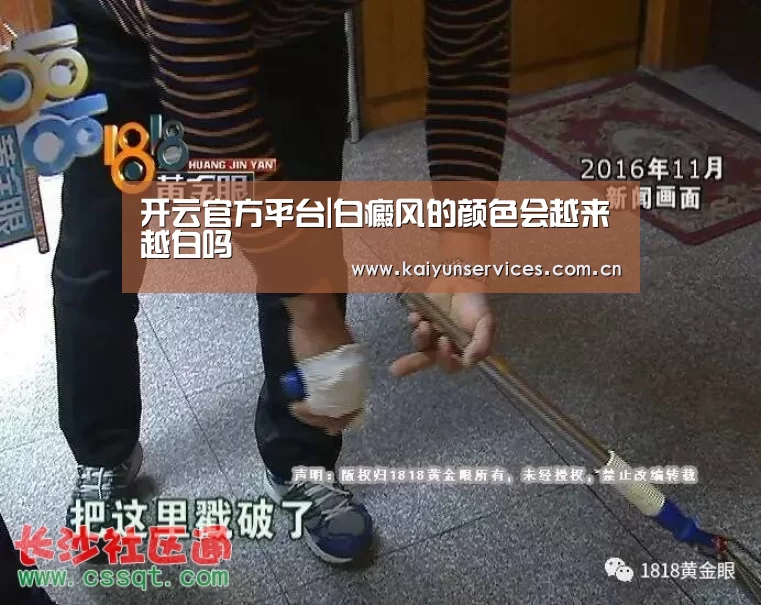 开云官方平台|白癜风的颜色会越来越白吗(图1) 开云中国官网